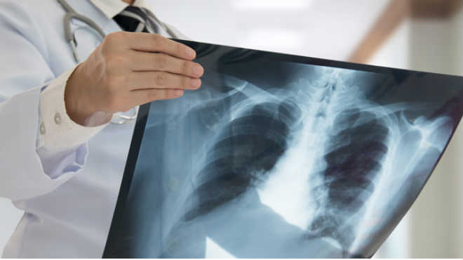 Ministerio de Salud activa vigilancia epidemiológica por caso de tuberculosis en colegio de Guayaquil